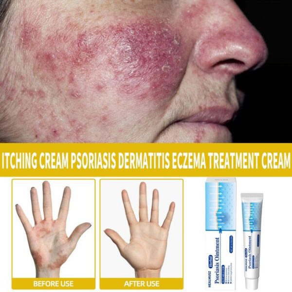 Antibacterial Psoriasis Cream Itch Eczema Relief Skin Rash