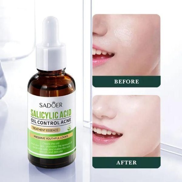 SADOER Salicylic Acid Serum for Face Shrink Pores, Gentle Exfoliating, Salicylic Acid for Anti Acne, Pimple, Spot, Blackhead Salicylic Acid Acne...